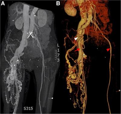 Case Report: Transcatheter closure of a giant post-traumatic femoral arteriovenous fistula using ventricular septal occluder